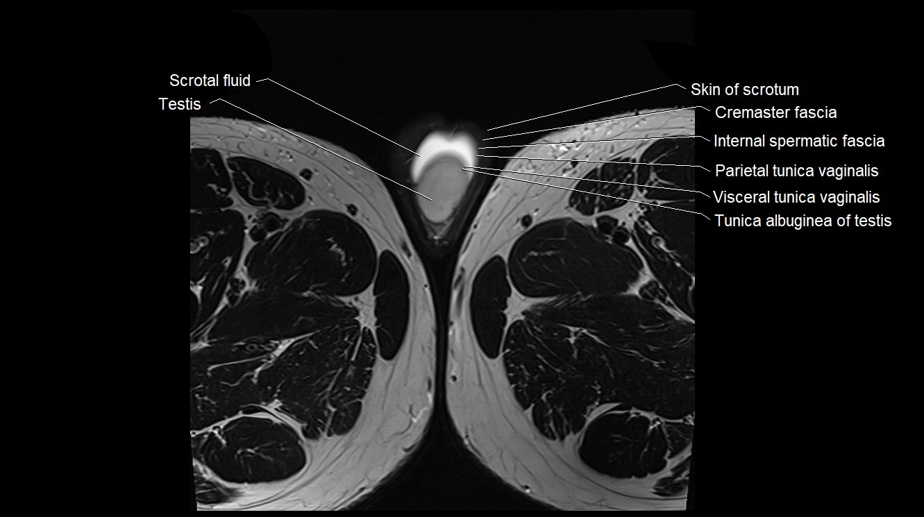 MRI 3T scrotum and penis axial cross sectional anatomy image 40.webp